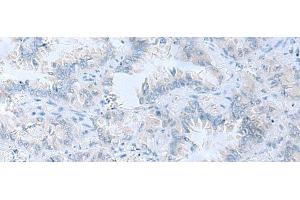 Immunohistochemistry of paraffin-embedded Human lung cancer tissue using ATP6V1C1 Polyclonal Antibody at dilution of 1:100(x200) (ATP6V1C1 Antikörper)