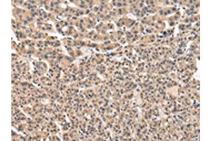 The image on the left is immunohistochemistry of paraffin-embedded Human liver cancer tissue using ABIN7131587(VPS41 Antibody) at dilution 1/20, on the right is treated with fusion protein. (VPS41 Antikörper)
