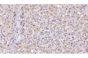 ABIN6273331 at 1/100 staining Human thyroid cancer tissue by IHC-P. (TIMM9 Antikörper  (C-Term))