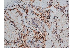 ABIN6267444 at 1/50 staining human colon cancer tissue sections by IHC-P.