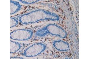 IHC-P analysis of Human Rectum Cancer Tissue, with DAB staining. (TPSAB1 Antikörper  (AA 161-262))