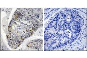 Immunohistochemistry analysis of paraffin-embedded human colon carcinoma, using Histone H1 (Phospho-Thr17) Antibody. (Histone H1 Antikörper  (pSer17))