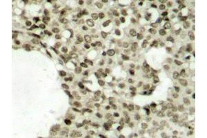 Immunohistochemistry of paraffin-embedded Human breast carcinoma tissue, using Phospho-STAT1(S727) Polyclonal Antibody (STAT1 Antikörper  (pSer727))