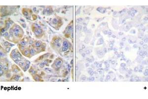 Immunohistochemical analysis of paraffin-embedded human breast carcinoma tissue using ITGB4 polyclonal antibody .