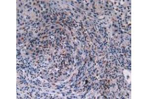 IHC-P analysis of Human Lung Cancer Tissue, with DAB staining. (MAT2A Antikörper  (AA 176-395))