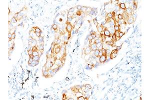 Formalin-fixed, paraffin-embedded human Lung SCC stained with Cytokeratin 7 Mouse Monoclonal Antibody (OV-TL12/30) (Cytokeratin 7 Antikörper)