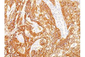Formalin-fixed, paraffin-embedded human Lung SqCC stained with EGFR Mouse Monoclonal Antibody (GFR/2341). (EGFR Antikörper  (AA 344-492))
