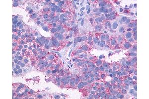 Anti-SIPR3 / EDG3 / S1P3 antibody IHC of human Ovary, Carcinoma. (S1PR3 Antikörper  (C-Term))