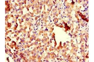 Immunohistochemistry of paraffin-embedded human lung cancer using ABIN7151005 at dilution of 1:100 (CHFR Antikörper  (AA 141-422))