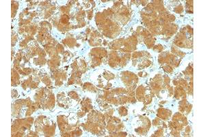 Formalin-fixed, paraffin-embedded human Thyroid Carcinoma stained with TSHRA Mouse Monoclonal Antibody (TSHRA/1402). (TSH receptor Antikörper)