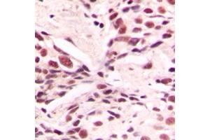 Immunohistochemical analysis of LMX1B staining in human breast cancer formalin fixed paraffin embedded tissue section.