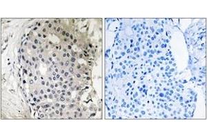 Immunohistochemistry analysis of paraffin-embedded human breast carcinoma tissue, using ARHGEF10 Antibody. (ARHGEF10 Antikörper  (AA 339-388))