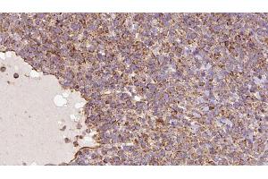 ABIN6273182 at 1/100 staining Human lymph cancer tissue by IHC-P.