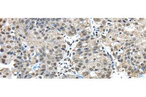 Immunohistochemistry of paraffin-embedded Human breast cancer tissue using FUS Polyclonal Antibody at dilution 1:45 (FUS Antikörper)