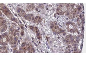ABIN6273882 at 1/100 staining Human liver cancer tissue by IHC-P. (GPR55 Antikörper  (Internal Region))