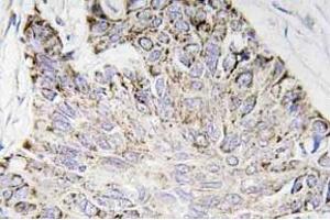 Immunohistochemistry (IHC) analyzes of Caspase-4 antibody in paraffin-embedded human lung carcinoma tissue. (Caspase 4 Antikörper)