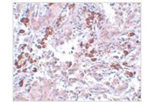 Immunohistochemistry of BCAS1 in human breast carcinoma with BCAS1 antibody at 5 µg/ml. (BCAS1 Antikörper  (C-Term))