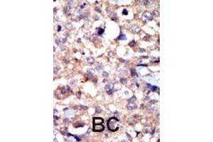 Formalin-fixed and paraffin-embedded human cancer tissue reacted with the primary antibody, which was peroxidase-conjugated to the secondary antibody, followed by AEC staining. (ABL1 Antikörper  (C-Term))