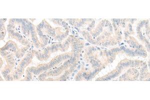 Immunohistochemistry of paraffin-embedded Human thyroid cancer tissue using AOAH Polyclonal Antibody at dilution of 1:25(x200)