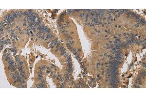 Immunohistochemistry of paraffin-embedded Human colon cancer using KIF22 Polyclonal Antibody at dilution of 1:30 (KIF22 Antikörper)
