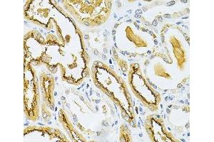 Immunohistochemistry of paraffin-embedded Human kidney cancer using GLRX Polyclonal Antibody at dilution of 1:200 (40x lens). (Glutaredoxin 1 Antikörper)