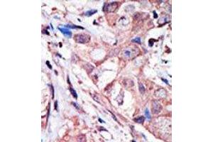 Formalin-fixed, Paraffin-embedded human cancer tissue stained with MAPK10 Antibody (N-term) Cat. (MAPK10 Antikörper  (N-Term))