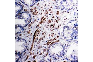 Anti-Mitochondrial Pyruvate dehydrogenase kinase 1 antibody, IHC(P) IHC(P): Human Prostatic Cancer Tissue (PDPK1 Antikörper  (C-Term))