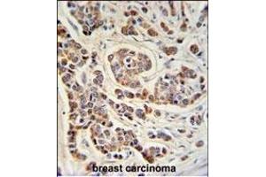 ATHL1 Antibody (C-term) (ABIN1881084 and ABIN2840111) IHC analysis in formalin fixed and paraffin embedded human breast carcinoma followed by peroxidase conjugation of the secondary antibody and DAB staining. (ATHL1 Antikörper  (C-Term))