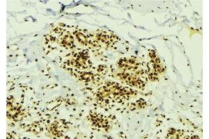 ABIN6273799 at 1/100 staining Human breast cancer tissue by IHC-P. (NEK2 Antikörper  (Internal Region))