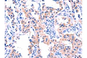 The image on the left is immunohistochemistry of paraffin-embedded Human thyroid cancer tissue using ABIN7190588(ERN2 Antibody) at dilution 1/40, on the right is treated with synthetic peptide. (ERN2 Antikörper)