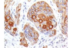Formalin-fixed, paraffin-embedded human Esophageal Tumor stained with CD86 Mouse Monoclonal Antibody (BU63).