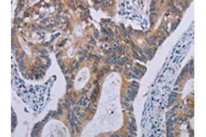 The image on the left is immunohistochemistry of paraffin-embedded Human colon cancer tissue using ABIN7190614(F2RL2 Antibody) at dilution 1/30, on the right is treated with synthetic peptide. (F2RL2 Antikörper)