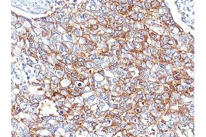 Formalin-fixed, paraffin-embedded human Breast Carcinoma stained with EpCAM Mouse Monoclonal Antibody (EGP40/826). (EpCAM Antikörper  (N-Term))