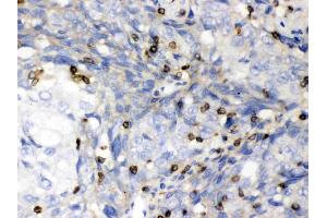 ABL2 was detected in paraffin-embedded sections of human lung cancer tissues using rabbit anti- ABL2 Antigen Affinity purified polyclonal antibody (Catalog # ) at 1 µg/mL. (ABL2 Antikörper  (AA 1065-1182))