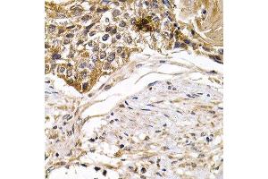 Immunohistochemistry of paraffin-embedded human breast cancer using ARRB2 antibody at dilution of 1:200 (400x lens). (Arrestin 3 Antikörper)