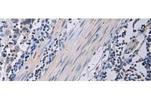 Immunohistochemistry of paraffin-embedded Human esophagus cancer tissue using ANGPTL2 Polyclonal Antibody at dilution of 1:55(x200) (ANGPTL2 Antikörper)