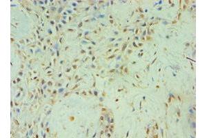 Immunohistochemistry of paraffin-embedded human breast cancer using ABIN7152459 at dilution of 1:100 (TBL1XR1 Antikörper  (AA 1-180))