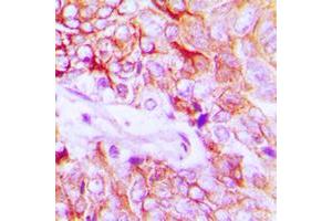 Immunohistochemical analysis of HER4 (pY1284) staining in human breast cancer formalin fixed paraffin embedded tissue section.