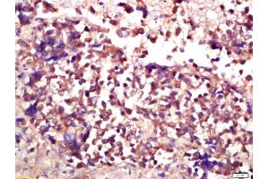 Formalin-fixed and paraffin embedded human lung carcinoma labeled with Anti-E2F3 Polyclonal Antibody, Unconjugated (ABIN733493) at 1:200 followed by conjugation to the secondary antibody and DAB staining (E2F3 Antikörper  (AA 381-465))