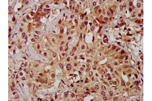 IHC image of ABIN7159972 diluted at 1:600 and staining in paraffin-embedded human liver cancer performed on a Leica BondTM system. (ERK2 Antikörper  (AA 310-360))