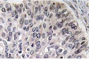 Immunohistochemistry analyzes of Carbonic anhydrase 2 antibody in paraffin-embedded human lung carcinoma tissue. (CA2 Antikörper)