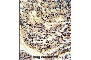 Formalin-fixed and paraffin-embedded human lung carcinoma reacted with BCL2A1 Antibody (Center), which was peroxidase-conjugated to the secondary antibody, followed by DAB staining. (BCL2A1 Antikörper  (AA 53-81))