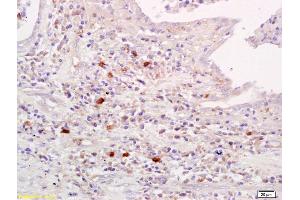 Formalin-fixed and paraffin embedded human lung carcinoma labeled with Anti-Amylin Polyclonal Antibody, Unconjugated (ABIN724280) at 1:200 followed by conjugation to the secondary antibody and DAB staining. (Amylin/DAP Antikörper)