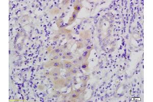 Formalin-fixed and paraffin embedded human hepatoma labeled with Anti-phospho C-Met/HGFR(Tyr1365), Unconjugated (ABIN733703) at 1:200, followed by conjugation to the secondary antibody and DAB staining (MEK1 Antikörper  (pSer298))