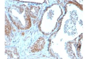 Formalin-fixed, paraffin-embedded human Prostate Carcinoma stained with TIGIT-Monospecific Mouse Monoclonal Antibody (TIGIT/3106). (TIGIT Antikörper  (AA 22-141))
