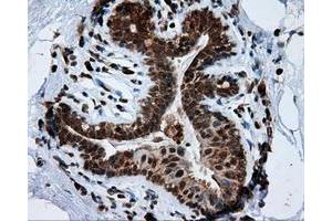 Immunohistochemical staining of paraffin-embedded breast tissue using anti-TPMT mouse monoclonal antibody. (TPMT Antikörper)