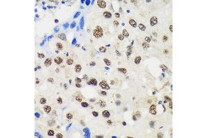 Immunohistochemistry of paraffin-embedded Human breast cancer using LB Rabbit pAb (ABIN6131871, ABIN6143090, ABIN6143091 and ABIN6217142) at dilution of 1:100 (40x lens).