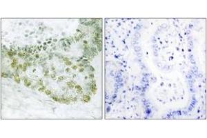 Immunohistochemistry analysis of paraffin-embedded human lung carcinoma tissue, using Hic-5 (Ab-60) Antibody.