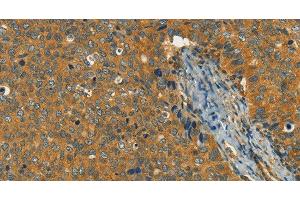 Immunohistochemistry of paraffin-embedded Human cervical cancer using KLC1 Polyclonal Antibody at dilution of 1:40