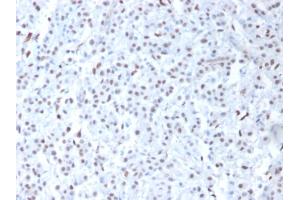 Formalin-fixed, paraffin-embedded human Mesothelioma stained with Wilm's Tumor Mouse Monoclonal Antibody (6F-H2).